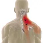 Мышечные узлы в шейно-плечевом отделе
